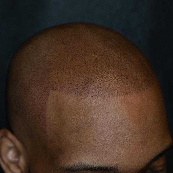 scalp micropigmentation training