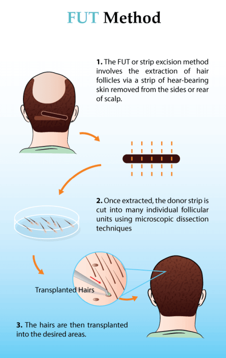 Follicular Unit Hair Transplant Procedure