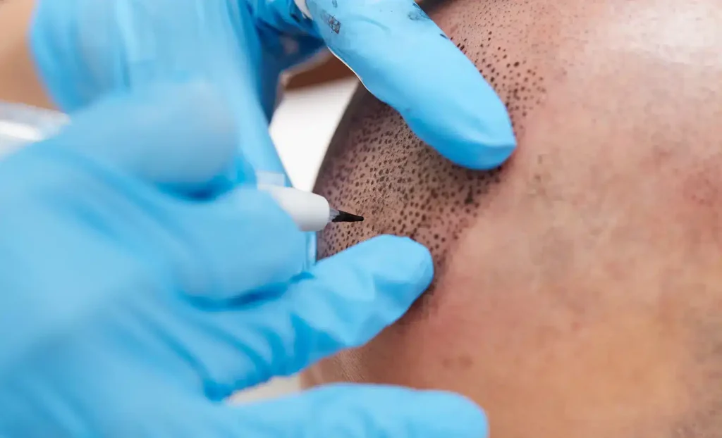 Scalp Micropigmentation Aftercare Tips | AzScalpDoctor