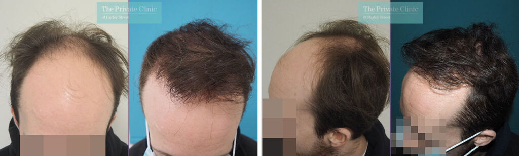 How Many Graft Hair Transplant Do You Need