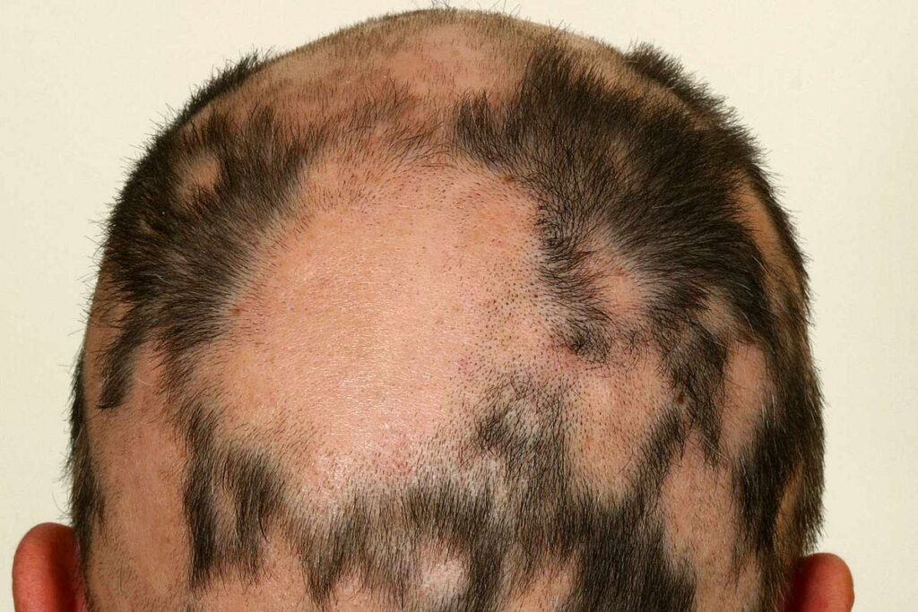 Alopecia Areata