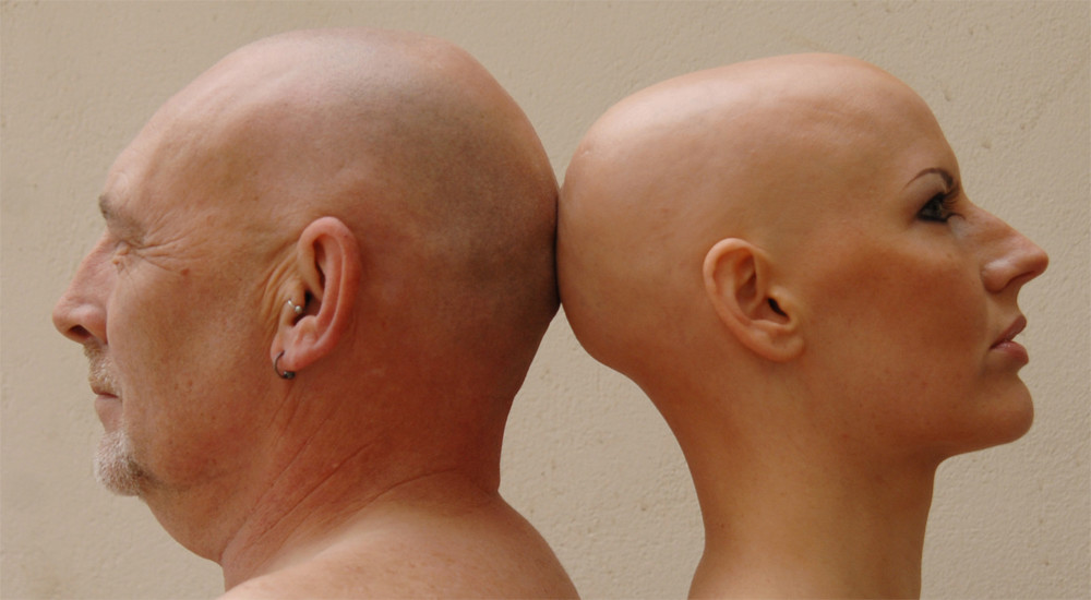 Alopecia Totalis