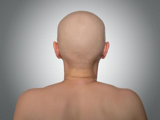 Alopecia Universalis