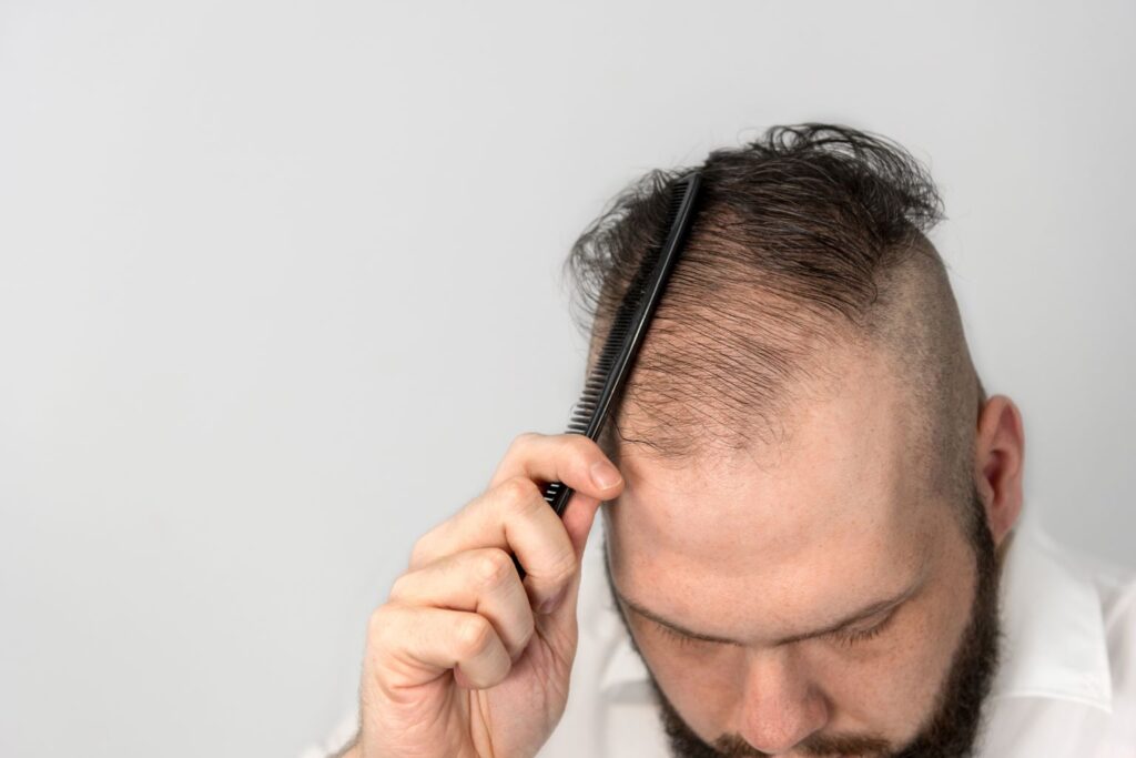 Androgenetic Alopecia