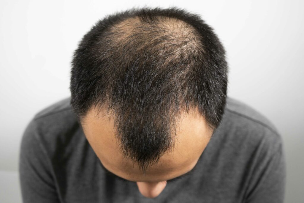 Androgenetic Alopecia Pada Pria