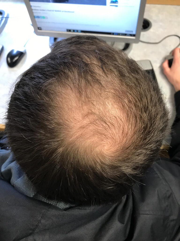 Androgenetic Alopecia Pada Pria
