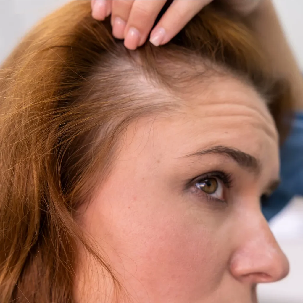 Androgenetic Alopecia Pada Wanita