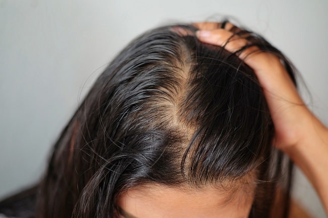 Androgenetic Alopecia Pada Wanita
