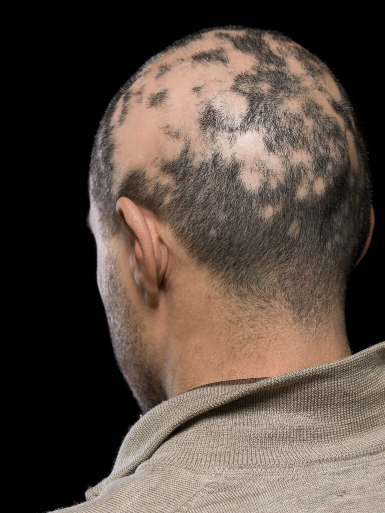 Jenis Alopecia