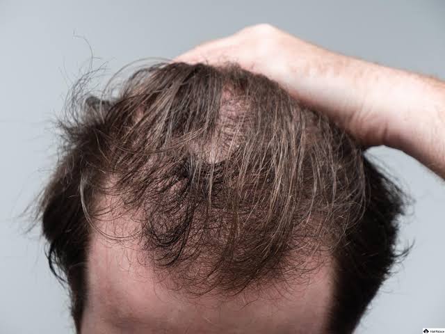Telogen Effluvium