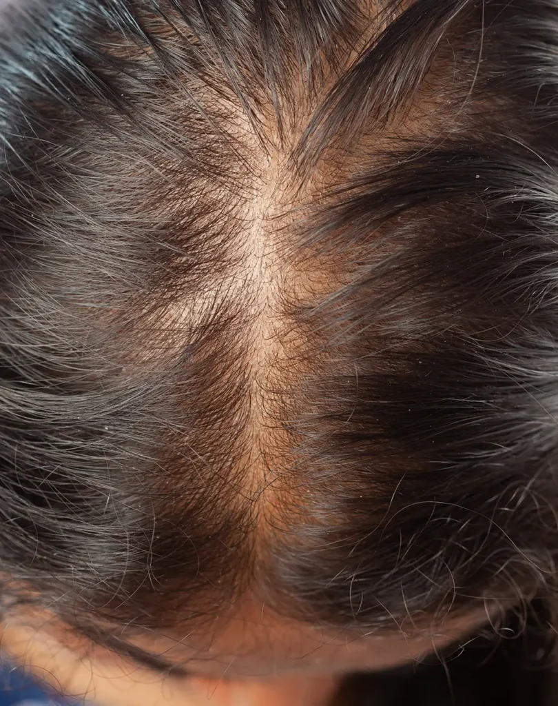 Traction Alopecia