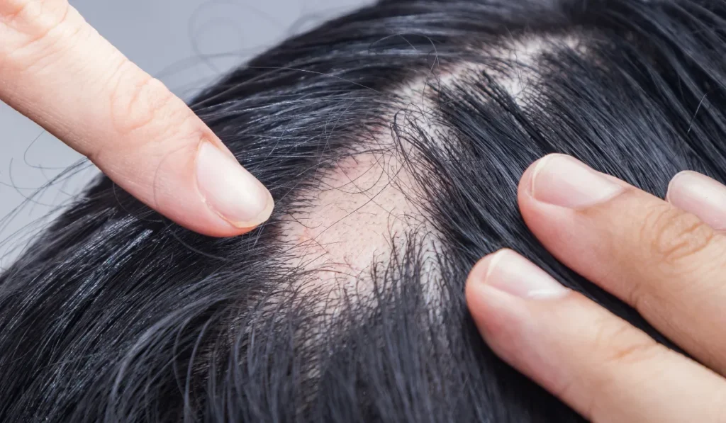Traction Alopecia