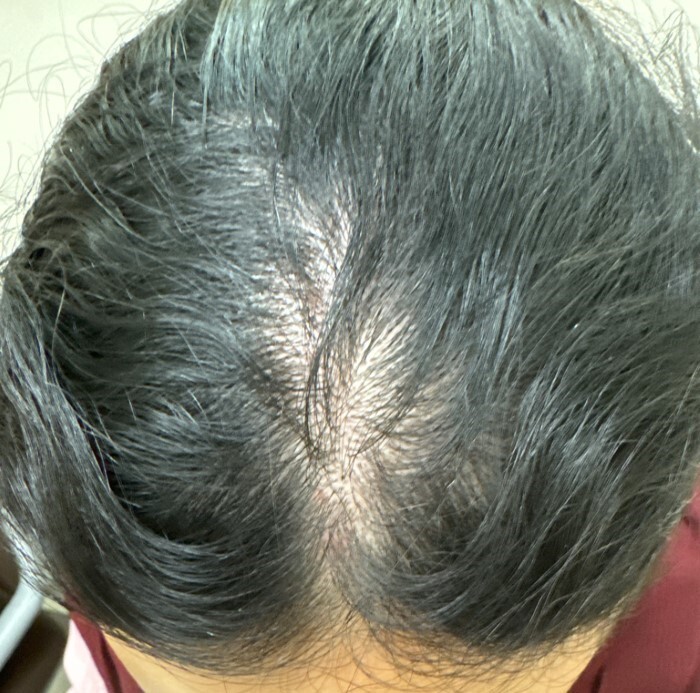 Penyebab Telogen Effluvium
