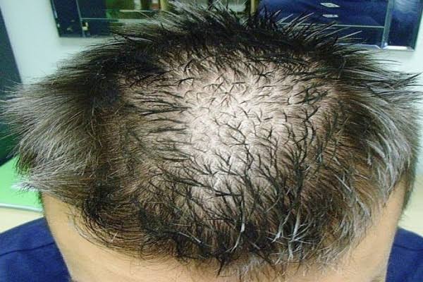 Telogen Effluvium Adalah