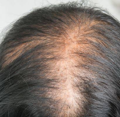 Telogen Effluvium Adalah